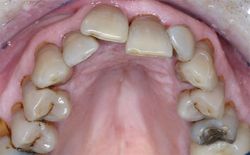 Tetracycline discoloration