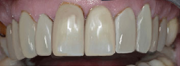 Tetracycline discoloration