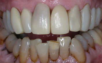 Tetracycline discoloration