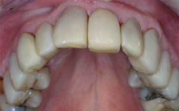 Tetracycline discoloration