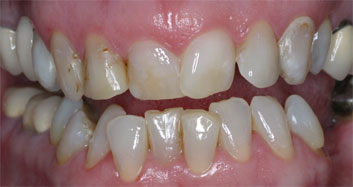 Crowding and discolorations