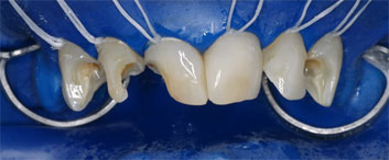 Crowding and discolorations