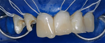 Crowding and discolorations