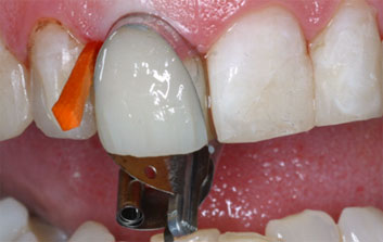 Crowding and discolorations