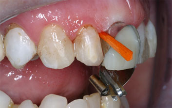 Crowding and discolorations