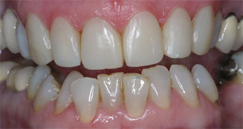 Crowding and discolorations