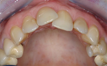 Crowding and old restorations