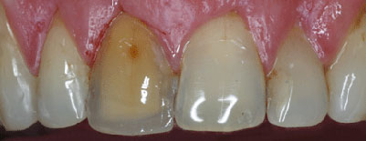Endo-discolorations