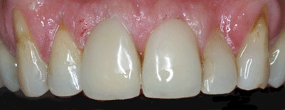 Endo-discolorations