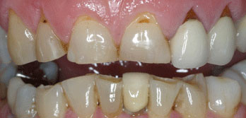 Severe incisal wear and old crowns