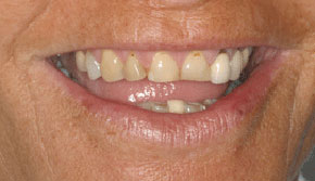 Severe incisal wear and old crowns
