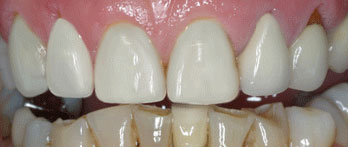 Severe incisal wear and old crowns