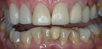 Severe incisal wear and old crowns