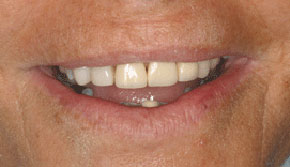 Severe incisal wear and old crowns