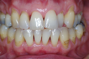 Direct resin venering