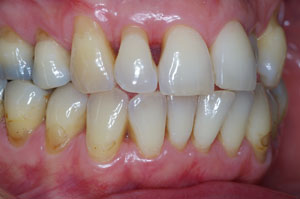Direct resin venering