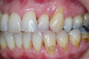 Direct resin venering