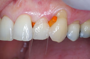 Direct resin venering