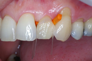Direct resin venering