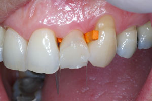 Direct resin venering