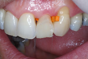 Direct resin venering