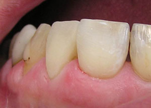 Direct resin venering