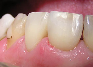 Direct resin venering