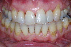 Direct resin venering