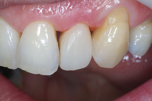 Direct resin venering