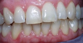 Quadrant restoration