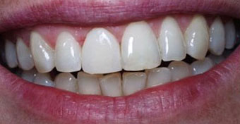Quadrant restoration