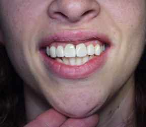 Quadrant restoration