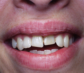 Quadrant restoration