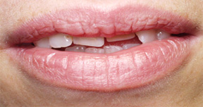 Quadrant restoration