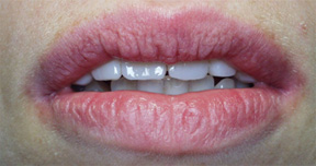 Quadrant restoration