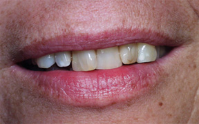 Quadrant restoration