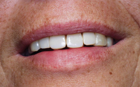 Quadrant restoration