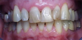 Quadrant restoration