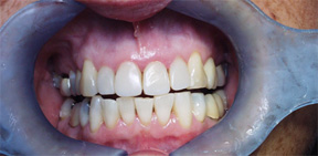 Quadrant restoration