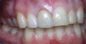 Discoloration under Porcelain Restoration