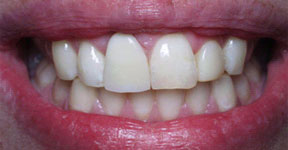 Discoloration under Porcelain Restoration