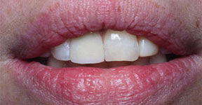Discoloration under Porcelain Restoration