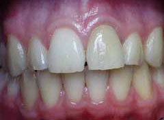 Incisor discoloration