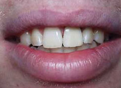 Incisor discoloration