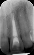 Incisor discoloration