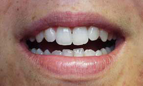 Restore length of lateral incisors