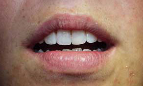 Restore length of lateral incisors