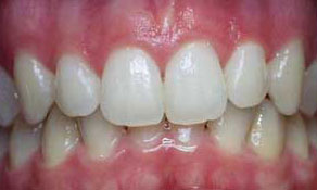 Restore length of lateral incisors