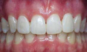 Restore length of lateral incisors