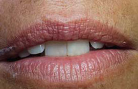 Restore tooth positions